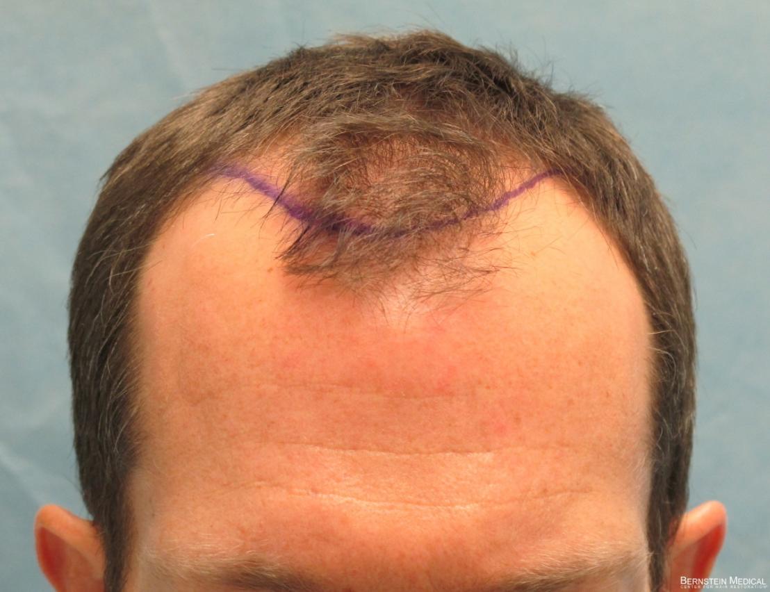 Position of Planned Hairline - Detail of Hairline