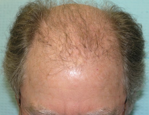 Click image for larger version

Name:	03_plugs-from-old-hair-transplant.jpg

Size:	62.7 KB
ID:	8896