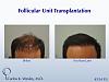 This 42-year-old man had two bad transplants at another office prior to coming to Dr. Wesley (NYC) for a revision of his hairline and subsequent mid...