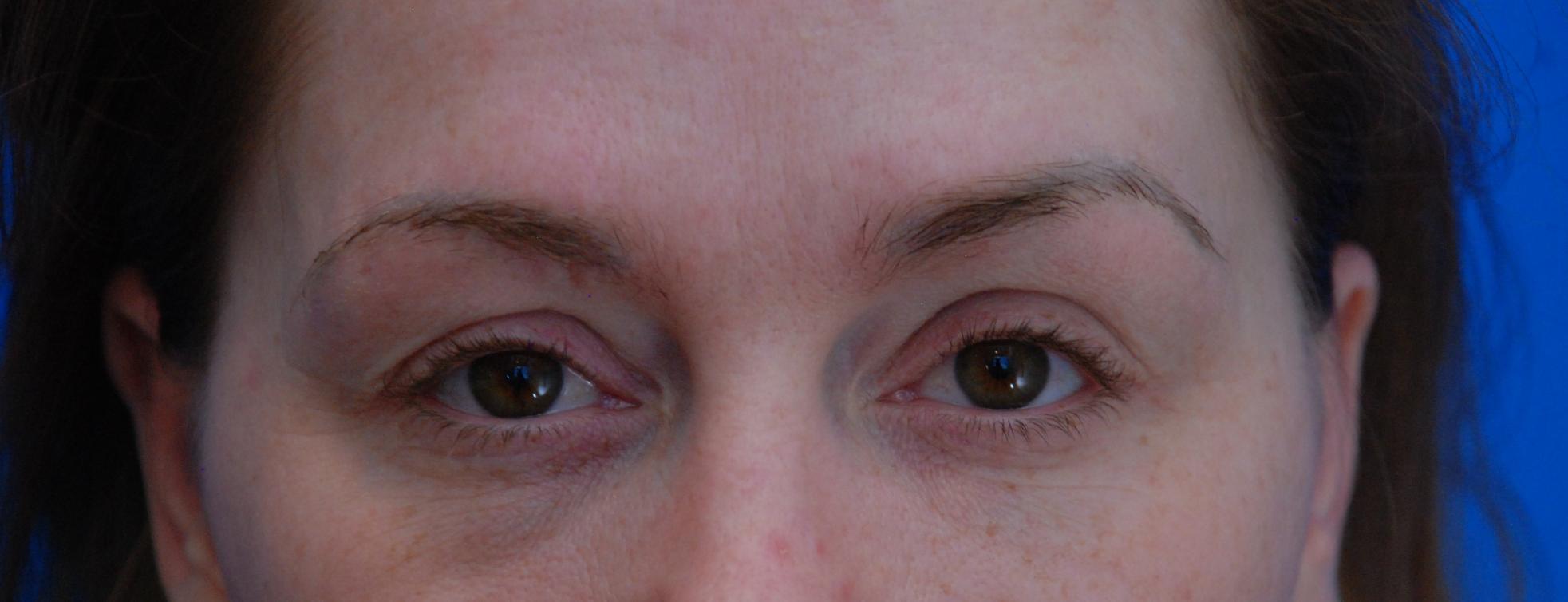 Click image for larger version

Name:	Cynthia eyebrows before.jpg

Size:	93.5 KB
ID:	56189