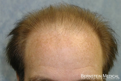 Click image for larger version

Name:	1-hairline.jpg

Size:	78.3 KB
ID:	39615