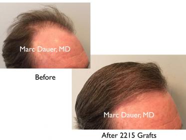 Click image for larger version

Name:	Hair Transplant Slides3.003.jpg

Size:	12.6 KB
ID:	42441