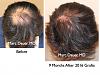 Click image for larger version

Name:	Hair Transplant Slides.106.jpg

Size:	91.8 KB
ID:	25474