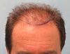 Position of Hairline