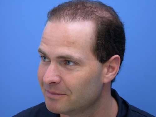 Unnatural hairline shape