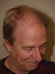 Side view before 2600 hair transplant grafts.