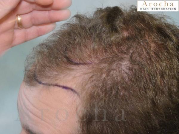 Twenty-nine year gentleman wanted to have a natural looking hair transplant to restore the framing of his face. Arocha Hair Restoration performed a...