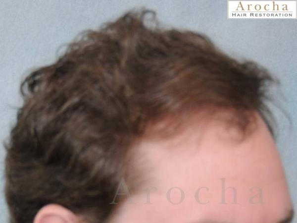 Twenty-nine year gentleman wanted to have a natural looking hair transplant to restore the framing of his face. Arocha Hair Restoration performed a...