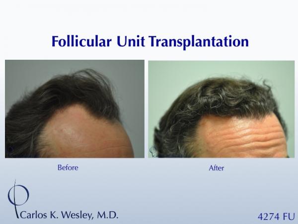 Before/After images of this 50-yr-old patient after a 4250-graft treatment by Dr. Carlos K. Wesley.  
 
A video of his transformation may be viewed...