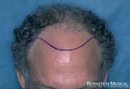 Click image for larger version

Name:	2-patient-lgk_1040_04position-of-hairline.jpg

Size:	52.9 KB
ID:	38062