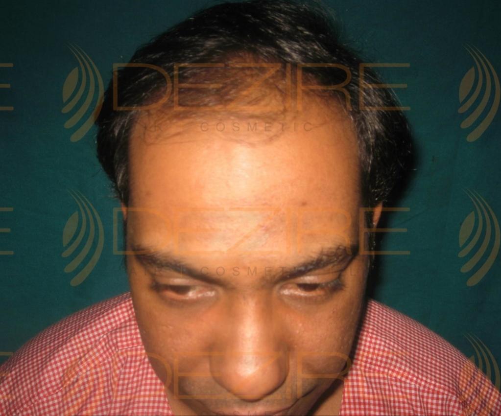 Click image for larger version

Name:	Hair Transplant Days.jpg

Size:	82.7 KB
ID:	55168