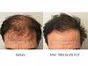 patient hair transplant result of Marc Dauer, MD