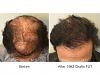 patient hair transplant result of Marc Dauer, MD