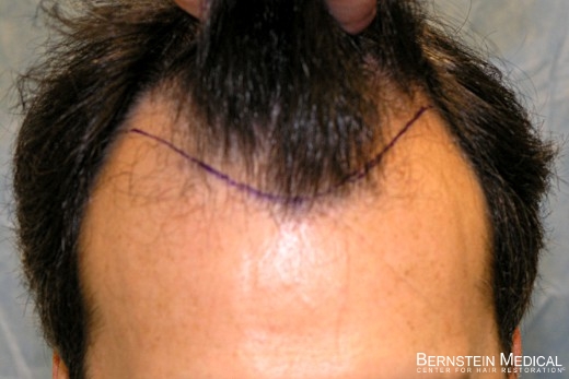 Click image for larger version

Name:	04_position-of-hairline.jpg

Size:	94.9 KB
ID:	44734