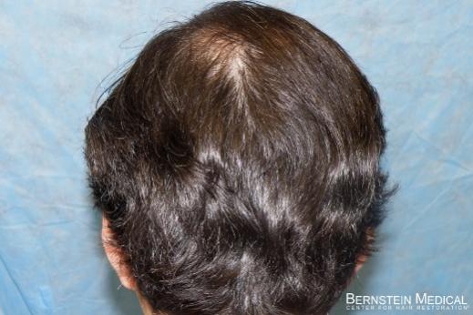 Click image for larger version

Name:	08_after-hair-transplant-back-view.jpg

Size:	29.9 KB
ID:	44737