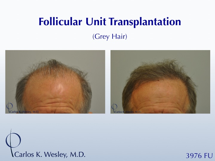 Before/After a treatment with 3976 grafts by Dr. Carlos K. Wesley in New York City. 
 
A video of this patient's transformation may be viewed here:...