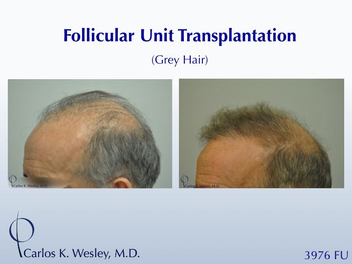 Before/After a treatment with 3976 grafts by Dr. Carlos K. Wesley in New York City. 
 
A video of this patient's transformation may be viewed here:...