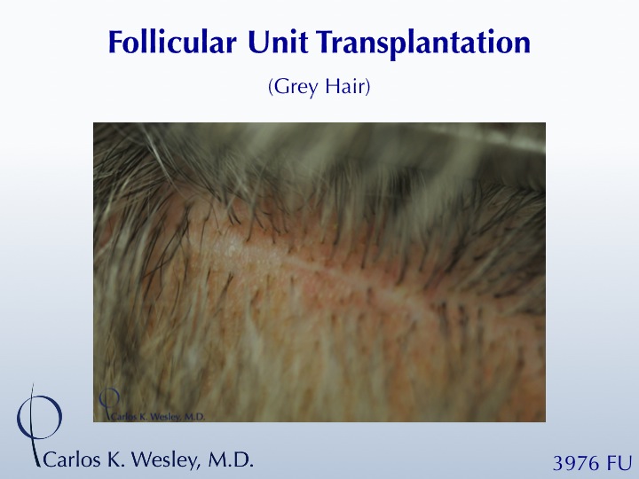 The patient's resultant donor scar after 3976 grafts via FUT with Dr. Carlos K. Wesley 
 
A video of this patient's transformation may be viewed...