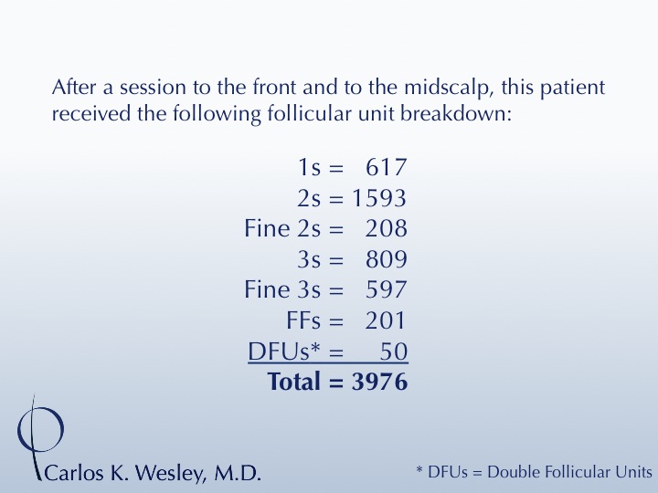 A treatment with 3976 grafts by Dr. Carlos K. Wesley in New York City. 
 
A video of this patient's transformation may be viewed here:...