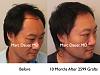 Click image for larger version

Name:	Hair Transplant Slides1.219.jpg

Size:	72.8 KB
ID:	34079