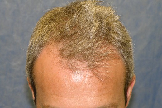 Click image for larger version

Name:	03_before-hair-transplant-top-view.jpg

Size:	56.0 KB
ID:	15598