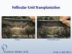 A 40-year-old male underwent a 2460 FU session of FUT with Dr. Carlos K. Wesley (NYC).  His donor area afterwards.