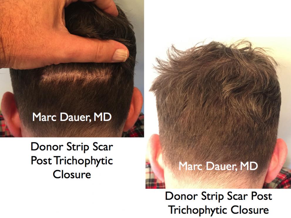 Click image for larger version

Name:	Hair Transplant Slides.739.jpg

Size:	92.0 KB
ID:	41371