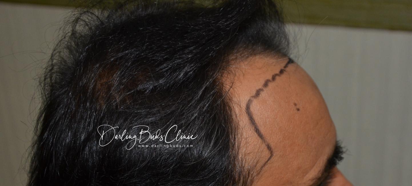 Click image for larger version

Name:	Darling Buds Clinic hair transplant pre op 5.jpg

Size:	96.9 KB
ID:	55399