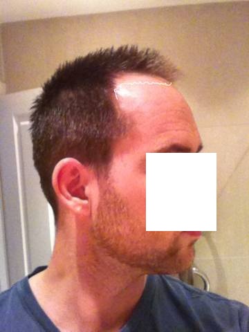 Click image for larger version

Name:	hairline1x.jpg

Size:	35.3 KB
ID:	11061