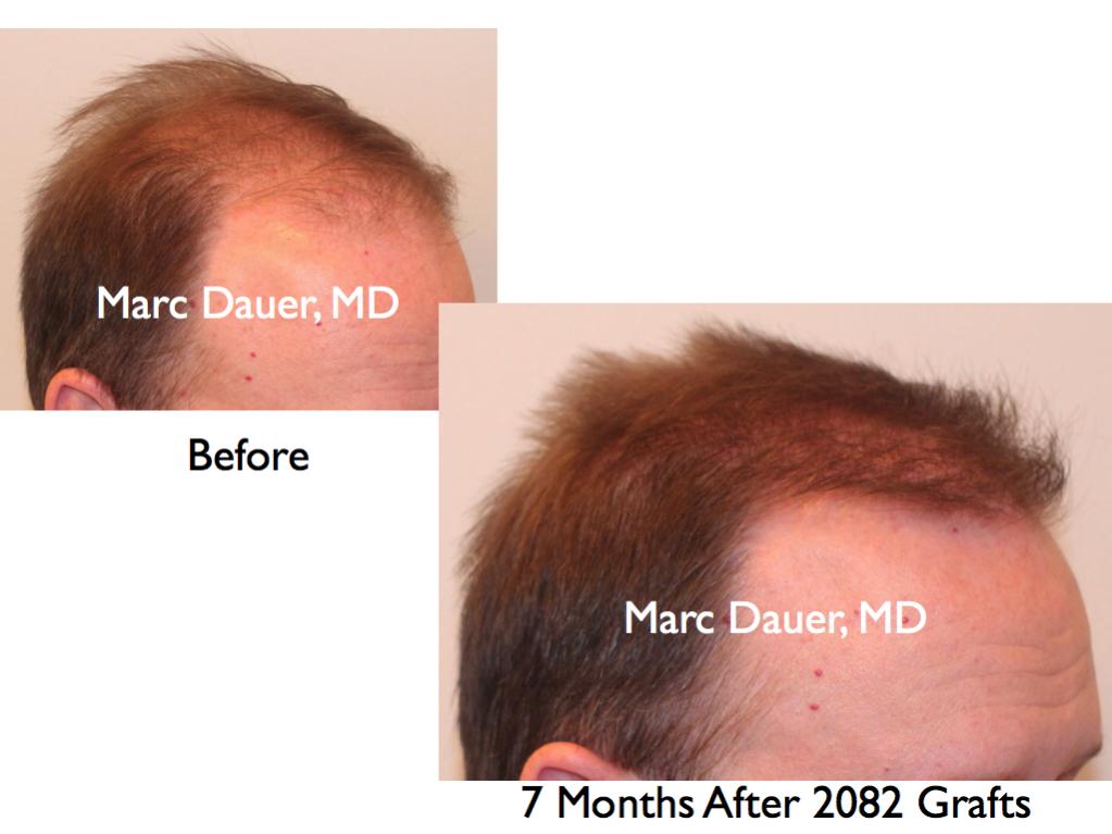 Click image for larger version

Name:	Hair Transplant Slides.265.jpg

Size:	58.5 KB
ID:	35173