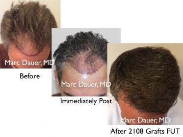 Click image for larger version

Name:	Hair Transplant Slides copy36.002.jpg

Size:	16.0 KB
ID:	45222