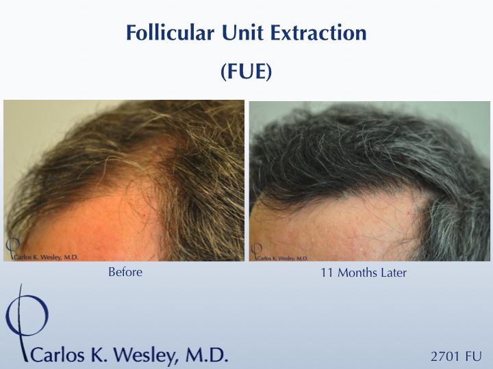 Follicular Unit Extraction (FUE) with Dr. Carlos K. Wesley in New York City.  Before/After 2701 FUE grafts using a combination of 0.8mm and 0.9mm...