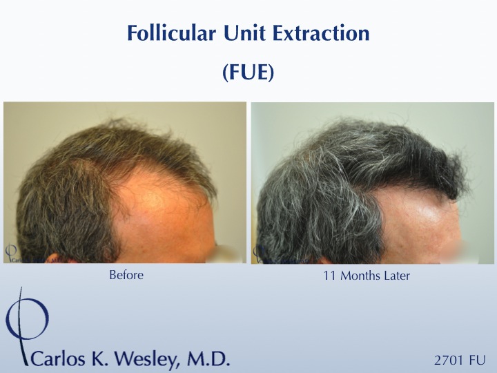 Follicular Unit Extraction (FUE) with Dr. Carlos K. Wesley in New York City.  Before/After 2701 FUE grafts using a combination of 0.8mm and 0.9mm...