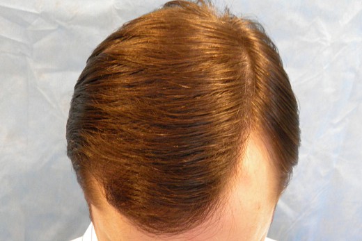 Click image for larger version

Name:	04_after-1st-hair-transplant-top-view.jpg

Size:	50.3 KB
ID:	16133