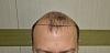 Click image for larger version

Name:	Best-FUE-hair-transplant-India (1).jpg

Size:	90.7 KB
ID:	53274