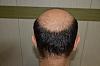 Click image for larger version

Name:	Best-FUE-hair-transplant-India (4).jpg

Size:	90.7 KB
ID:	53277