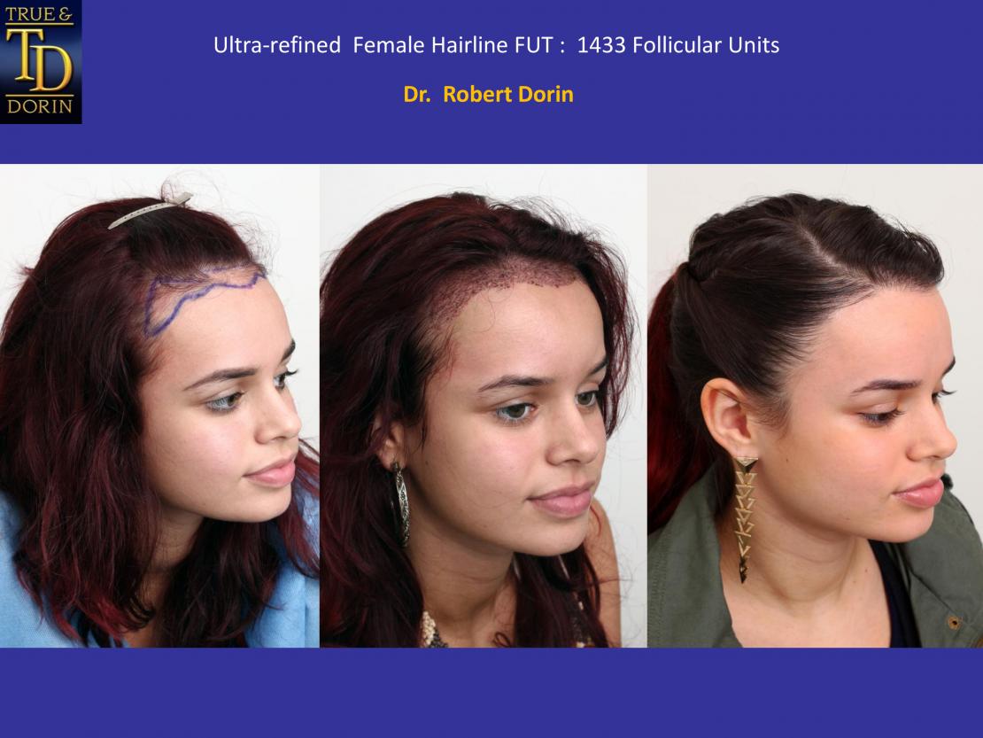 Female Ultra-refined Hair Transplant