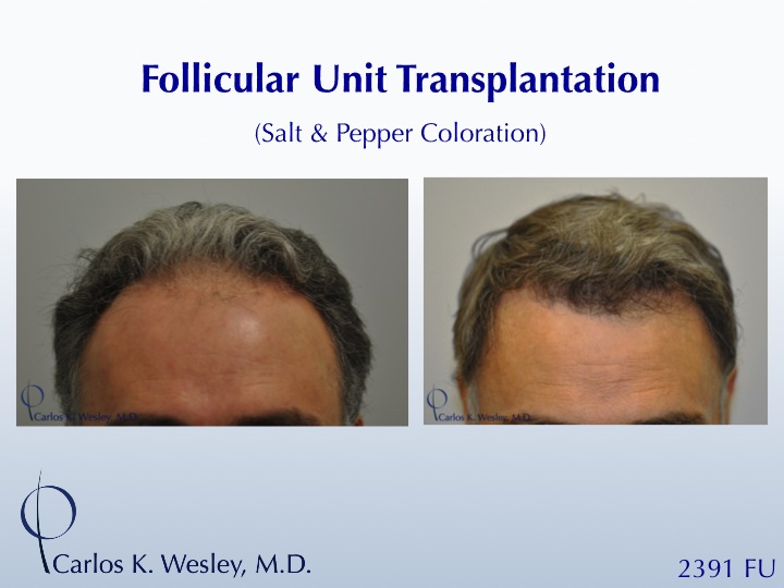 This patient is seen Before/After a 2391 graft 
session with Carlos K. Wesley, M.D. 
 
An interactive Before/After image of this patient can be...