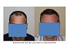 Dr. Paul Shapiro, MD  
FUT  
5207 grafts/ 11,661 hairs 
3 surgical sessions 
12 months post-op session 3