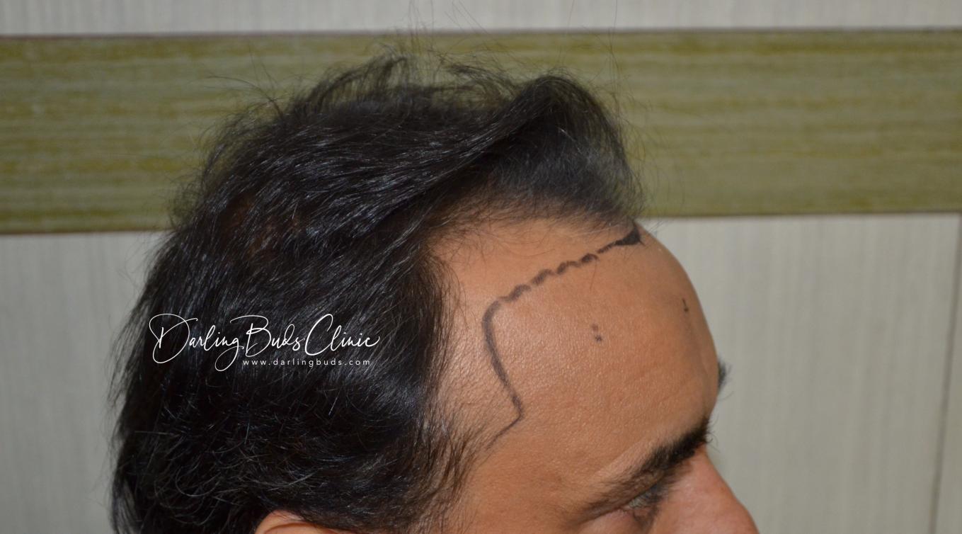 Click image for larger version

Name:	Darling Buds Clinic hair transplant pre op 4.jpg

Size:	92.6 KB
ID:	55398