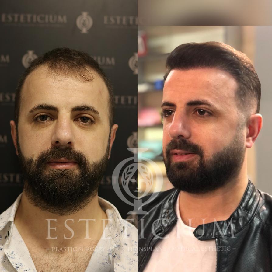 Hair Transplant Before - After