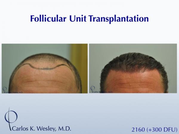 This 40-year old underwent surgical hair restoration with Dr. Carlos K. Wesley (NYC).  He received 2460 grafts (300 of which were DFUs) and presented...