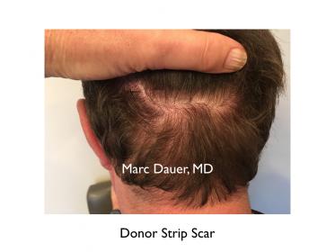 Click image for larger version

Name:	Hair Transplant Slides copy20.005.jpg

Size:	11.8 KB
ID:	44552