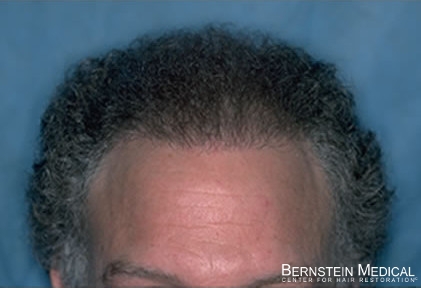 Click image for larger version

Name:	4-patient-lgk_1040_06after-1st-hair-transplant.jpg

Size:	57.8 KB
ID:	38064