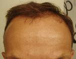 A very little was done to the front where my receding hairline is showing but you would think that 2381 grafts would be able to at least make a...