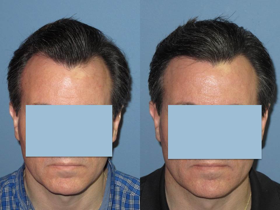 Dr. Paul Shapiro 
FUT 1395 grafts 
12 months post op