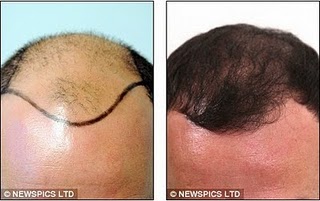 Click image for larger version

Name:	Jason_Gardiner_reveals_surgeon_s_pre_operative_photograph_after_22_000_hair_transplant_7.jpg

Size:	18.9 KB
ID:	11379