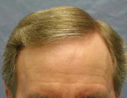 Click image for larger version

Name:	04_after-hairline-restoration.jpg

Size:	58.2 KB
ID:	7112