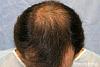 Click image for larger version

Name:	06_before-hair-transplant-top-view.jpg

Size:	26.3 KB
ID:	44735