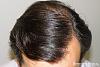 Click image for larger version

Name:	07_after-hair-transplant-top-view.jpg

Size:	26.2 KB
ID:	44736